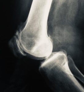 ¿Qué es la artroscopia de rodilla?