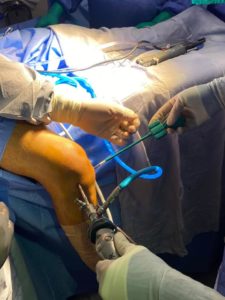 cirugía articular y artroscopía en Puebla